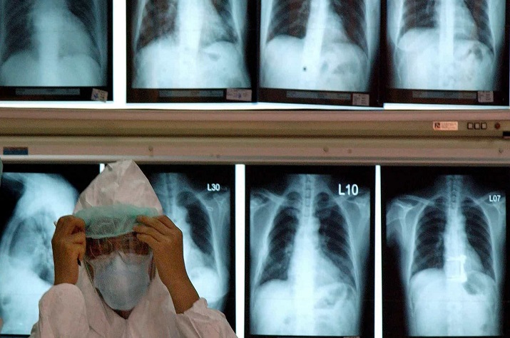 Doente de Covid-19 recebe transplante de pulmões do marido e do filho