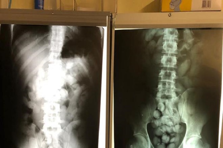 Traficante de droga detido no Aeroporto Internacional 4  de Fevereiro com 50 cápsulas de cocaína