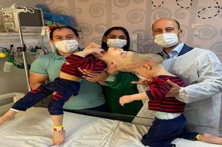 Médicos brasileiros separam gémeos siameses unidos pela cabeça, cirurgia durou 27 horas e juntou cem médicos