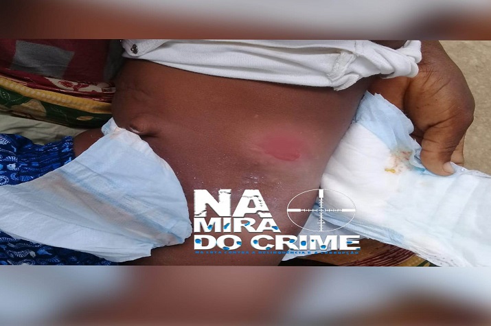 Falta assistência: Médicos do Hospital Pediátrico humilham família de criança operada por anomalia anorretal