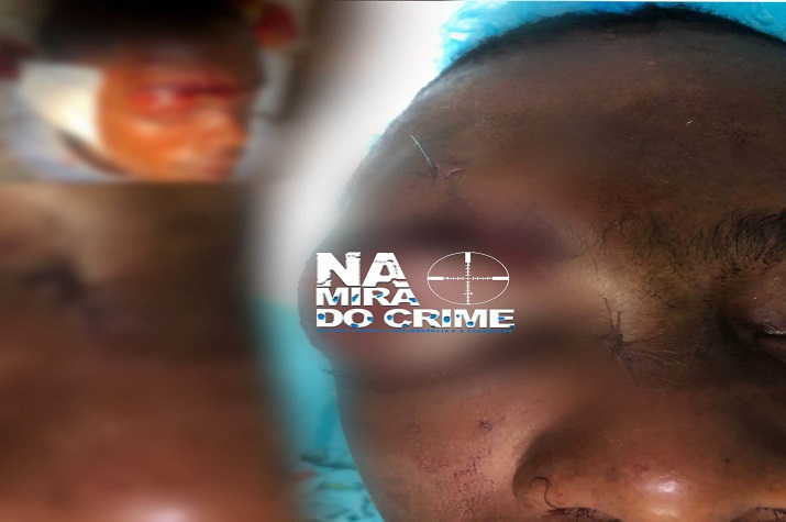 O segredo da Polícia: Agente agredido brutalmente durante o funeral de Nagrelha vai ficar sem os dois olhos, colega foi morto à pancada