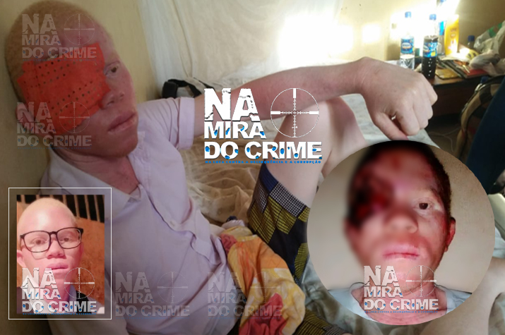 Jovem albino com câncer da pele em sofrimento atroz apela por ajuda