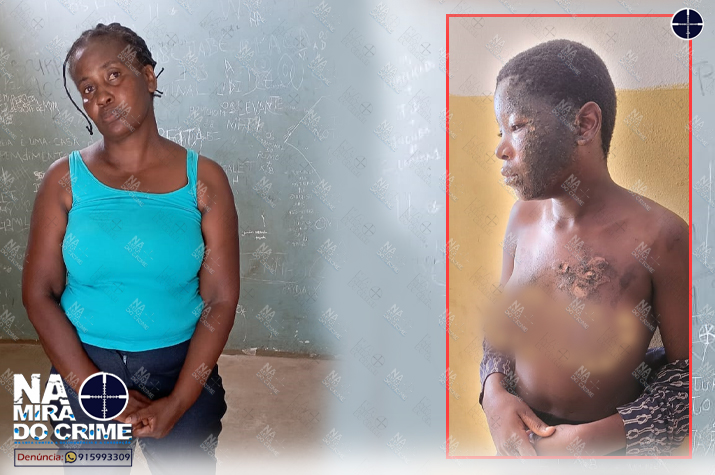 Tia queima a face e o tronco da sobrinha de 14 anos com água quente por partir uma tampa de panela