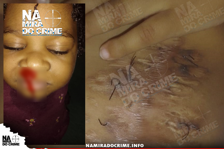 Menor de 05 anos de idade com fístula vaginal precisa de apoios para ser tratada na Alemanha