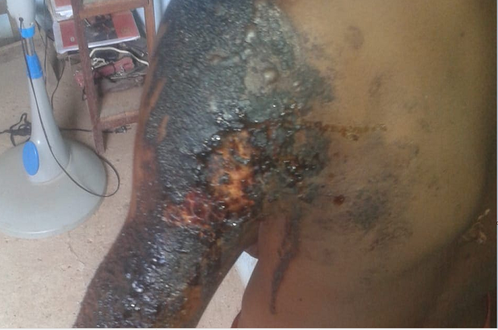 Menor de 14 anos electrocutado quando furtava fios e parafusos de um PT
